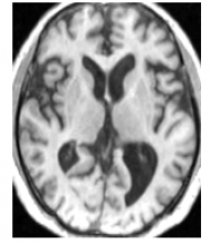 a brain mri