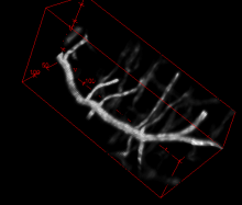 The extracted Volume of Interest  (3D rendering)